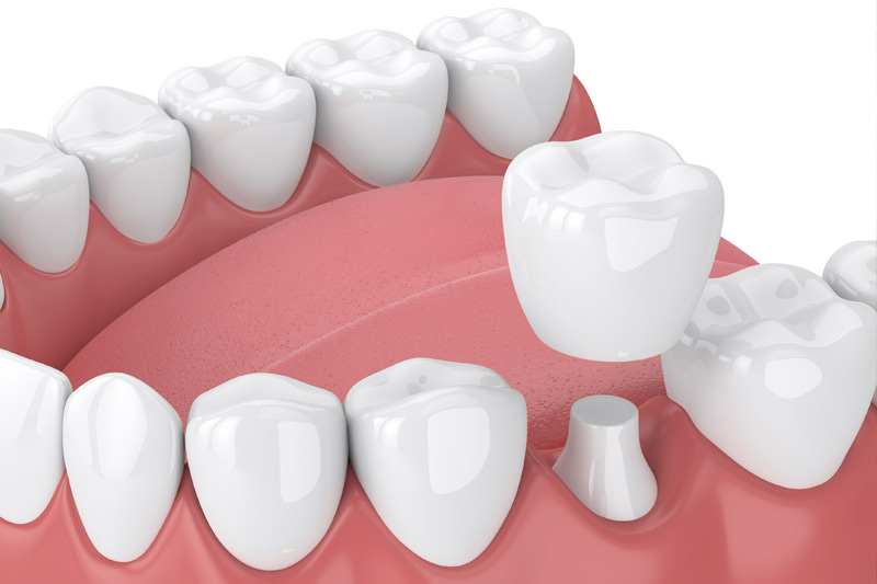 Dental Crowns in Madison