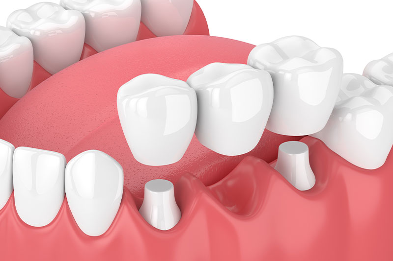 Dental Bridges in Madison