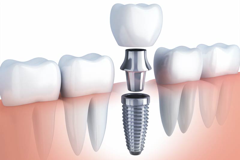 Implants Dentist in Madison