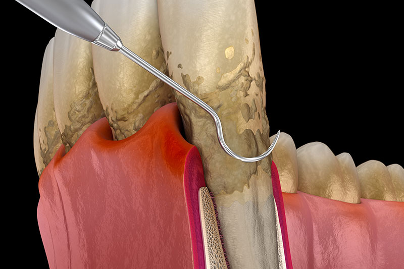 Gum Periodontal Disease in Madison