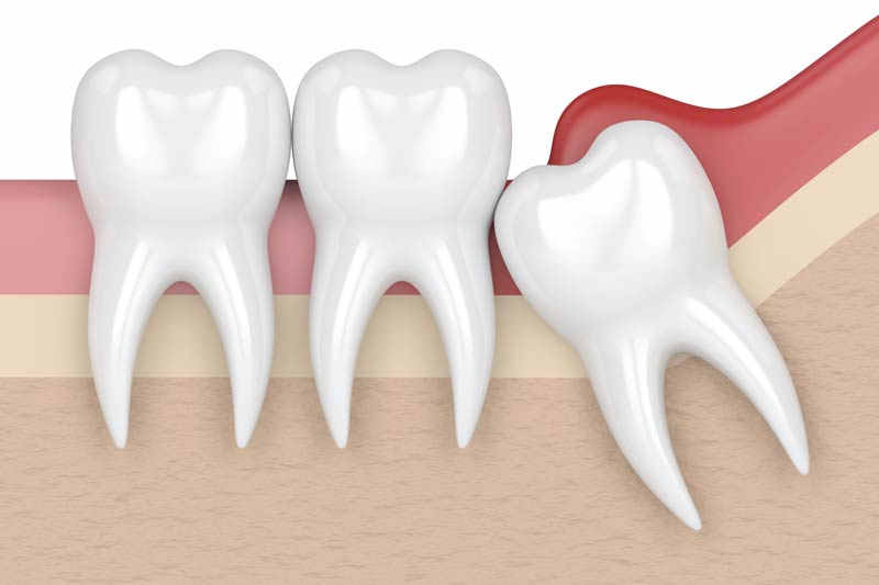 Wisdom Tooth Removal in Madison